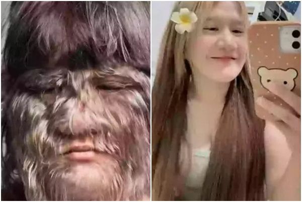 '늑대소녀'라 불리던 20대 태국 여성이 최근 털을 모두 없앤 근황이 화제다. 사진=SNS