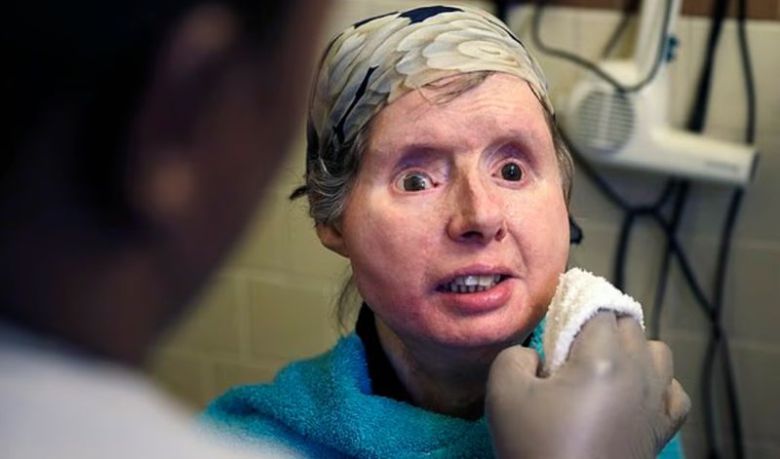 사고 후 안면 이식 수술을 받은 찰라 내시. 출처=데일리메일