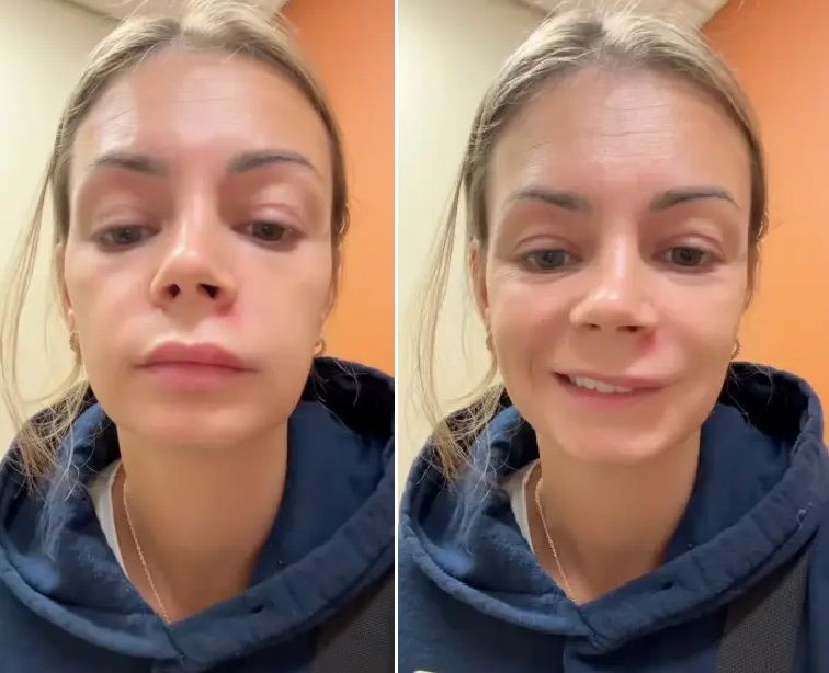 미국 여성 리시 마리가 코 부위 '죽음의 삼각형'에 난 여드름을 짜지 말라고 경고했다. 출처=뉴욕포스트, 틱톡