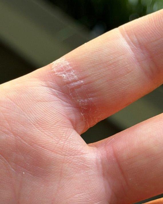 유튜버 다니엘 로타가 열을 내며 부풀어 오른 갤럭시 링 때문에 손가락에 화상을 입었다며 자신의 X에 공개한 사진. /사진=다니엘 로타 X캡처.