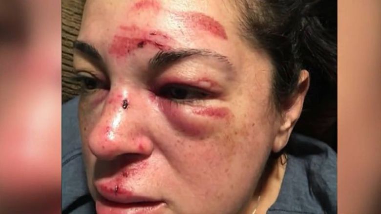 길을 걷던 중 보도블록에 걸려 넘어져 큰 상처를 입은 미국인 여성. NBC 방송 화면 캡처