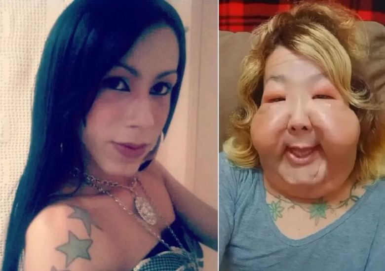 브라질 인플루언서가 불법 시술을 받기 전(왼쪽)과 현재의 모습. 출처=인스타그램, 더 선