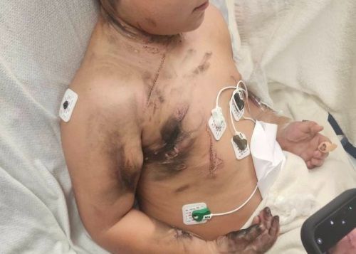 침대에서 휴대폰을 충전한 채 자던 8세 소년이 감전 사고를 당했다.