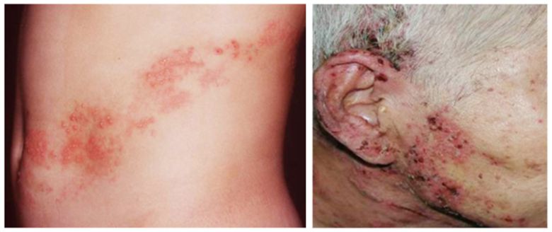 대상포진의 초기 증상은 신체의 한 쪽에서 나타나는 찌릿하거나 화끈거리는 통증이다. 보통 통증이 2~3일 정도 지속된 뒤 신경을 따라 띠 모양으로 발진이 나타난다. 사진=질병관리청·국민건강관리포털