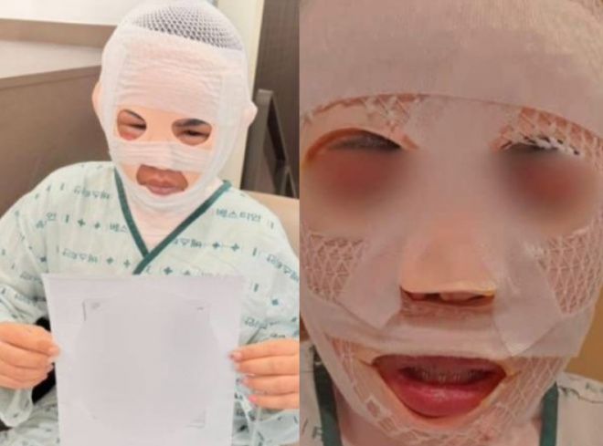 잠을 자고 있던 태국인 아내의 얼굴에 끓는 물을 부어 화상을 입힌 40대 한국인 남성이 경찰에 붙잡혔다. 이 남성은 아내가 다른 남성을 만나는 것이 두려워 이 같은 범행을 저질렀다고 주장했다.사진=SNS 캡처