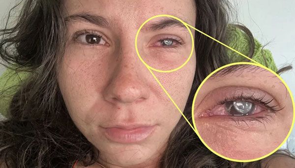 미국의 한 여성이 멕시코 여행 중 각막에 기생충이 감염된 사연을 공개했다./사진=더선