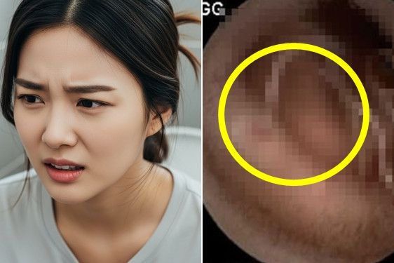 기사 이해를 돕기 위해 AI로 생성한 이미지(좌), 사례 여성의 소장에 기생충이 붙어있는 모습./사진=멕시코 위장병학회지(우)