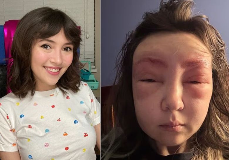 눈썹 염색 부작용으로 얼굴이 부어오른 여성. 출처=데일리메일