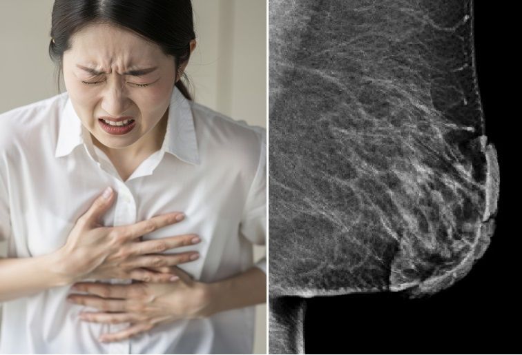 왼쪽 사진 유두-유륜 복합체의 피부가 두꺼워져 있다. 출처=큐레우스, 게티이미지뱅크