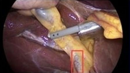 AI 보조 담낭절제술 중 담낭절제삼각 식별 화면. 한림대의료원 제공