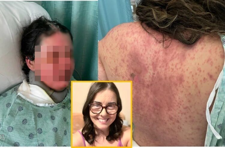 흔히 처방되는 항경련제 복용 이후 발생한 희귀 중증 약물 부작용으로, 30대 여성이 전신 피부의 대부분을 잃고 영구적 실명에 이른 사례가 보고됐다. 사진=SNS