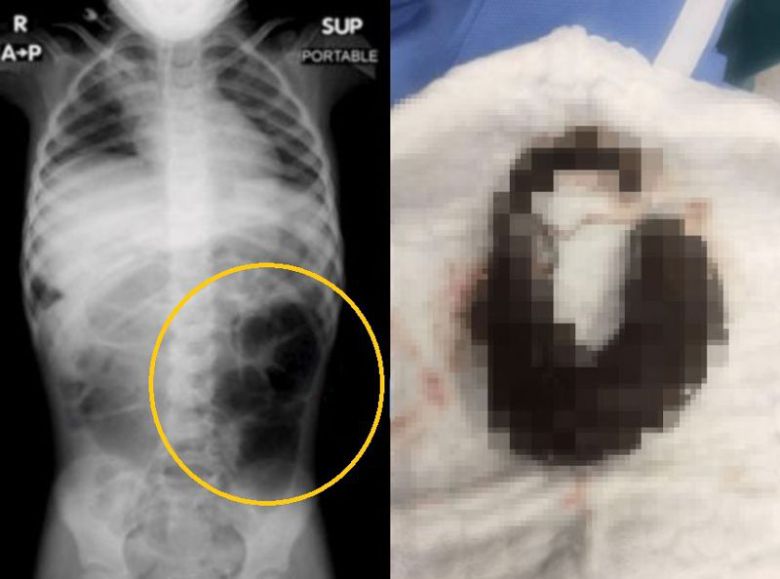 복통을 호소하던 6세 여아의 뱃속에서 머리카락 덩어리가 발견됐다. 사진=큐레우스저널