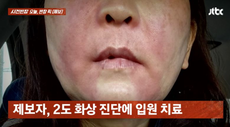 마트에서 구매한 곱창을 구워 먹다가 얼굴에 화상을 입은 A씨/사진=JTBC '사건반장' 캡처
