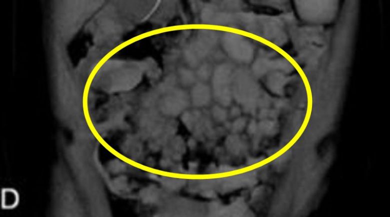 혈액암을 진단받은 20대 여성이 회충에 감염된 후 사망한 사례가 보고됐다. 사진은 장 주변 림프절 비대, 장중첩 발생한 사례 여성 복부CT/사진=큐레우스