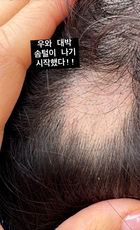 직접 촬영한 이 사진은 회복 중인 그 순간을 고스란히 보여주며 보는 이들의 응원을 이끌어냈다.사진=박성광 SNS