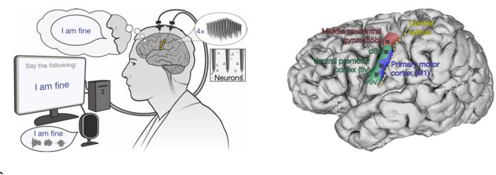 환자가 말하고 싶은 생각을 떠올리면, AI가 이를 읽어낸 뒤 음성으로 전환해 준다. [사진=네이처]