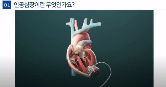 3세대 인공심장 하트메이트3 삽입 수술을 한 모습. [삼성서울병원 영상 캡처]