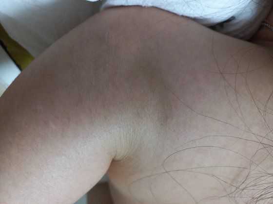 초등학교 4학년 B양 어깨에 생긴 멍 자국. B양 부모 측은 "A교사가 딸이 원치 않았는데도 어깨를 세게 주물러 멍이 생겼다"며 "안마를 가장한 체벌"이라고 주장하고 있다. [사진 B양 부모]