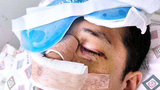 한국알콜산업 내에서 화물연대 조합원인 동료 직원에게 폭행당한 A씨. 눈 등 얼굴이 크게 다쳐 두달째 병원 치료를 받고 있다. 사진 A씨