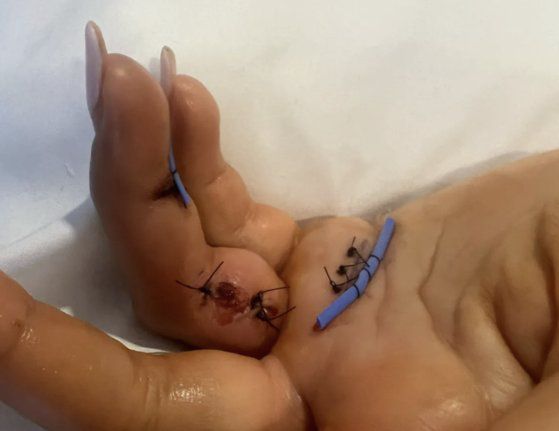 지난해 말 개에 물린 앨리슨 리의 손. 사진 앨리슨 리