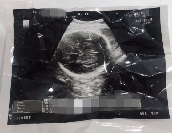 36주차 낙태 의혹이 불거진 영상 관련 태아 초음파 사진 캡처. 사진 인스타그램