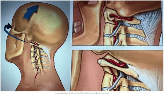 격렬한 목 마사지 시 목 혈관·신경 손상 우려. 사진 티라밧 헤마추다 교수 페이스북 캡처