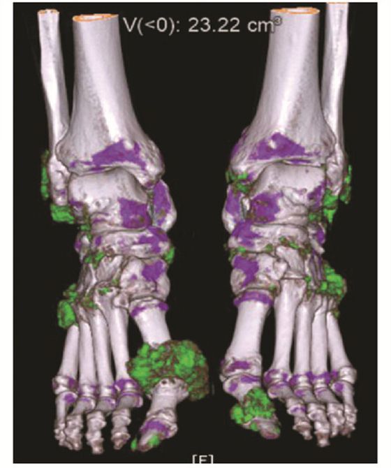 이중에너지 컴퓨터단층촬영으로 본 환자의 발. 초록색 부분이 요산 덩어리가 생긴 '통풍 결절'이다. 사진 대한류마티스학회
