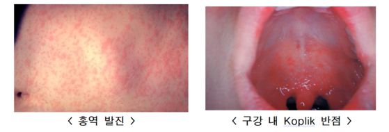 홍역 증상은 초기에 감기처럼 기침, 콧물, 결막염 등이 나타나고, 고열과 함께 온몸에 발진이 나타난다. 사진 미국질병관리본부, 질병관리청