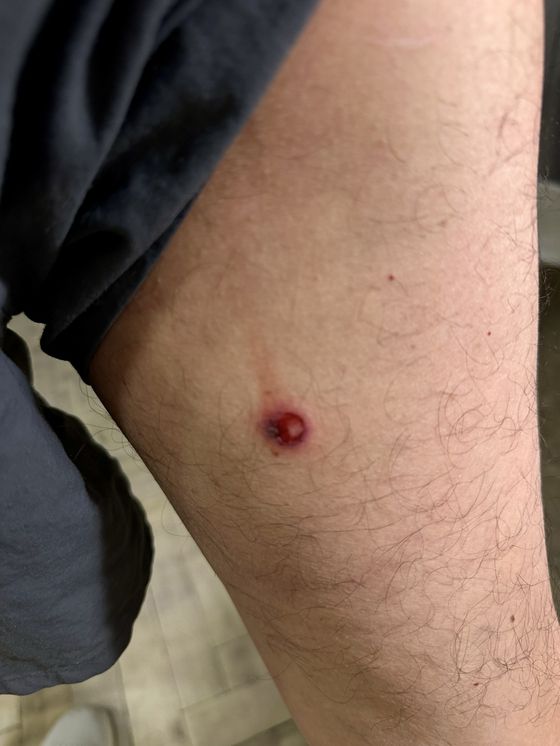 시위 취재 중 경찰의 고무탄 세 발을 맞은 장열 기자의 종아리 부위. 김상진 기자