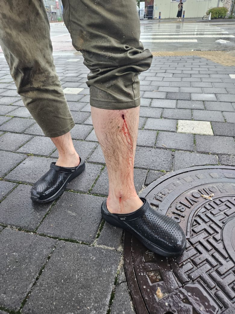 지난 21일 남원에서 발생한 땅 꺼짐(싱크홀) 사고로 다친 박모(46)씨. 인도가 2m 아래로 무너지면서 오른쪽 팔꿈치와 왼쪽 다리 피부가 벗겨지고 파여 피가 나고 있다. 사진 박씨