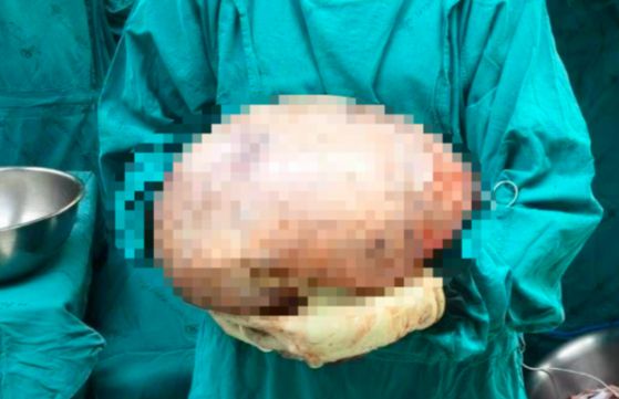 태국 의료진이 30대 여성 몸에서 제거한 난소 난종을 들고 있다. 사진 채널7 캡처