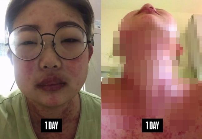 최준희가 공개한 과거 루프스 투병 시절 모습. 사진ㅣ최준희SNS