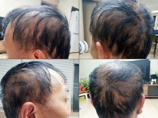 세종시에 거주하는 김모(53) 씨가 지난달 말 모더나 백신 2차 접종 이후 심각한 탈모 증세를 겪고 있다고 7일 말했다. [이미지출처=연합뉴스]