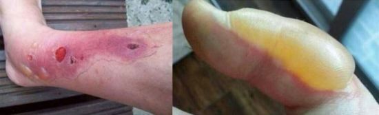 큰멧돼지풀의 줄기, 잎, 꽃, 씨앗, 뿌리 등에서 분비되는 수액에 '퓨라노쿠마린(Furanocoumarin)'이란 성분이 있기 때문에 사람에게 매우 유해하다. 온라인 커뮤니티