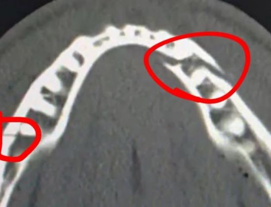 제이크 폴이 공개한 2군데 턱뼈 골절 엑스레이 사진. 제이크 폴 SNS 갈무리