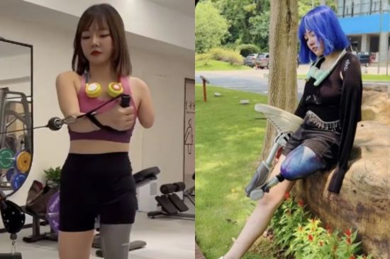 교통사고로 왼쪽 팔과 다리를 잃은 중국인 인플루언서 웡신이(30). SCMP