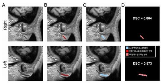 3차원 원본 이미지(A)를 토대로 전문가가 수동으로 직접 표시한 주름(B)과 AI가 예측해 자동으로 표시한 영역(C). 분당서울대병원