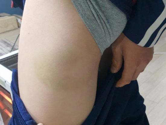 피해 아동 허벅지에 난 멍 자국. [사진=연합뉴스]