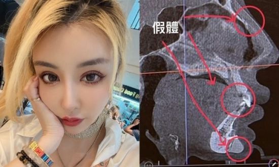 성형수술을 19번 한 대만 30대 여성이 얼굴 나사 때문에 공항검색대에 걸렸다고 고백했다. [사진=팡 기원 SNS]