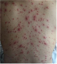 수두. 출처 서울대병원