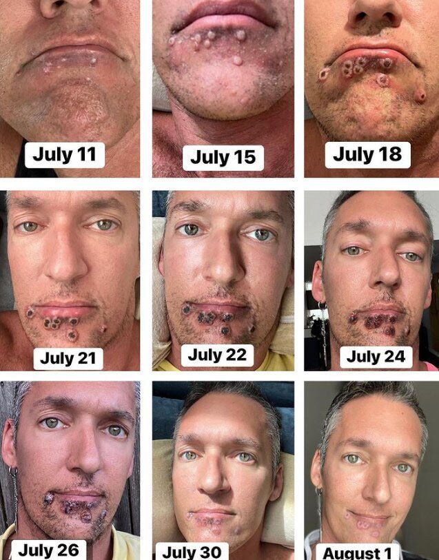 날짜별로 기록해 둔 원숭이두창 감염 상태(사진=인스타그램)