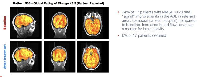 NE3107 임상 2상 결과 데이터 일부 (자료=바이오비)