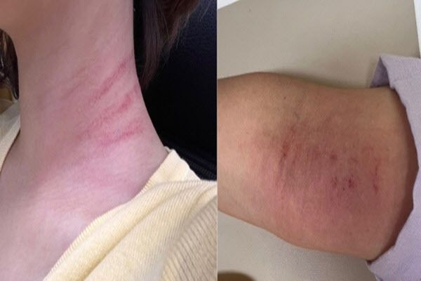 B양에게 폭행당해 생긴 A교사의 상처들. (사진=연합뉴스)