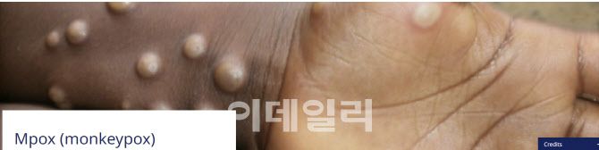 원숭이두창(엠폭스) 이미지. (제공=WHO)