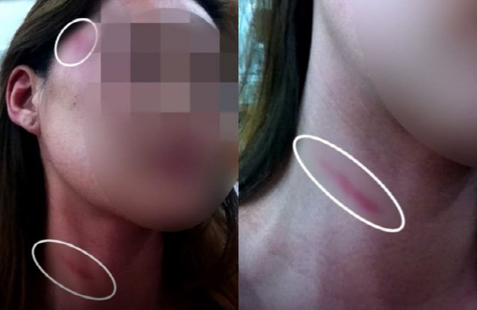 2013년 이태원 클럽에서 제시 일행으로부터 폭행을 당한 피해자 A씨. (사진=JTBC 사건반장 캡처)