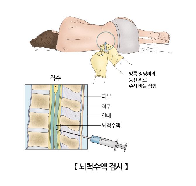 뇌척수액 검사 방법 (자료=서울아산병원)