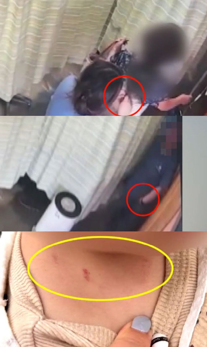 간호조무사 범행 장면과 아이 목에 남은 상처다. (사진=JTBC ‘사건반장’ 캡처)