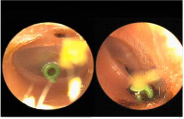 환기관(V-tube)삽입.