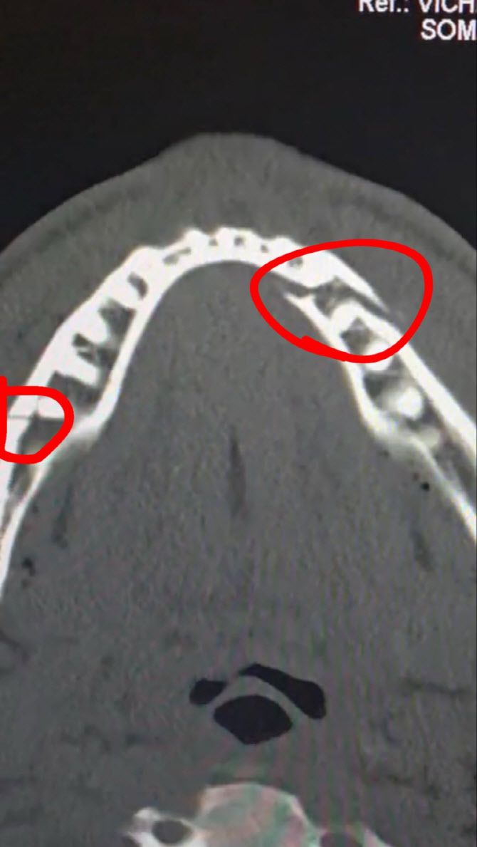 제이크 폴의 턱 엑스레이. 사진=제이크 폴 SNS