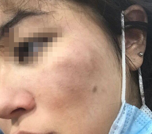 폭행당한 제나 두푸이가 올린 사진. /인스타그램